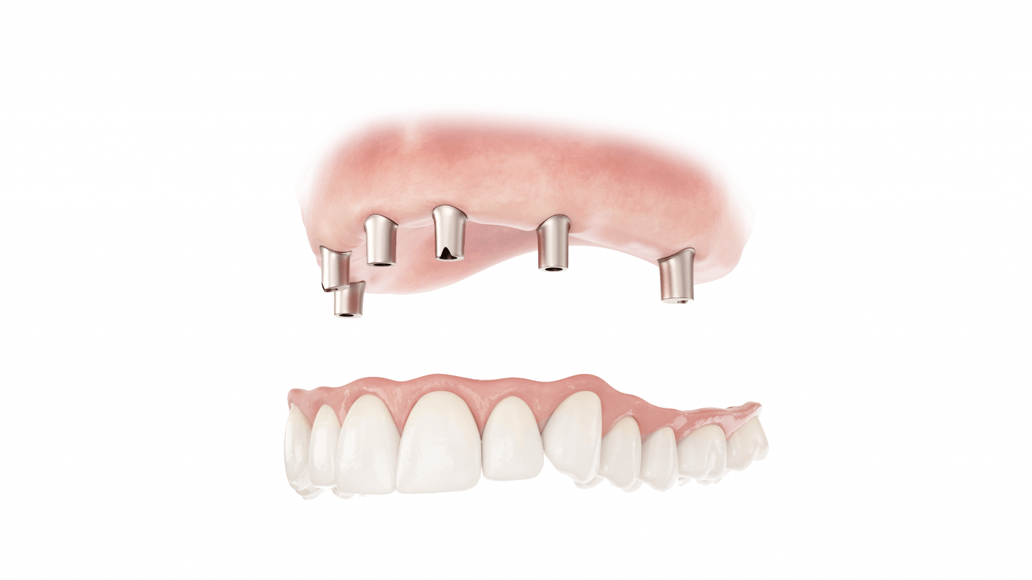 How Much Do Dentures Cost In Ontario McCabe Dentures Implants   1226566 Atlantis Conus Abutment Custom 01 Gpm 2048x1151 