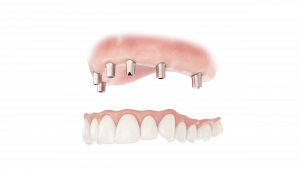 image of a denture